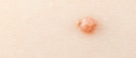 Thirteen Natural Home Remedies for Warts Removal