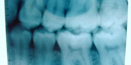Pros and Cons of Wisdom Teeth Removal