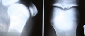 Bone Spur Symptoms and Treatment