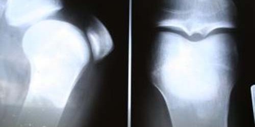 Ewing's Sarcoma Symptoms and Treatment