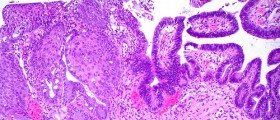 Pap Smear: Test for Abnormalities