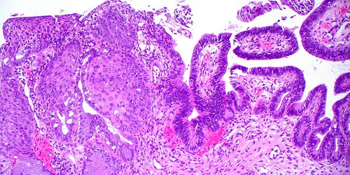 Pap Smear: Test for Abnormalities