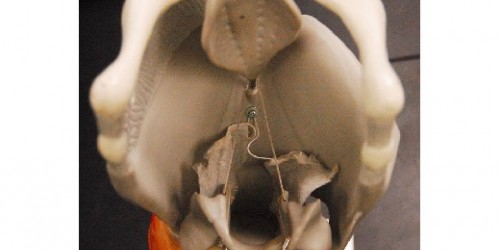 Infection of the Epiglottis