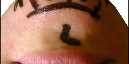 All about Chin Augmentation and Implants