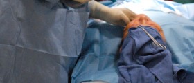 Facelift (Rhytidectomy): Procedure, Risks, and Recovery
