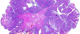 Home Treatments For Hemorrhoids
