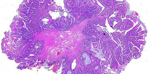 Home Treatments For Hemorrhoids