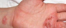 Dermatitis and Eczema Home Remedies