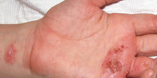Dermatitis and Eczema Home Remedies