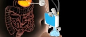 Aspireassist: Medically Induced Bulimia For Quick Weight Loss