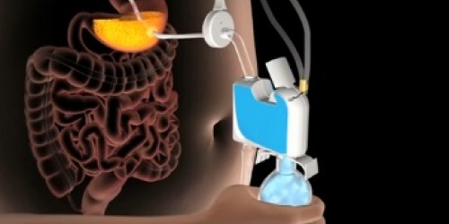 Aspireassist: Medically Induced Bulimia For Quick Weight Loss