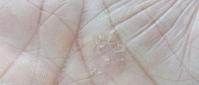 The Ten Most Common Psoriasis Triggers