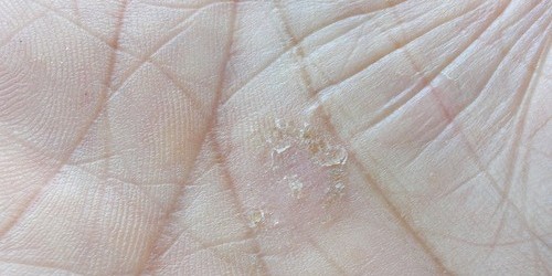 The Ten Most Common Psoriasis Triggers