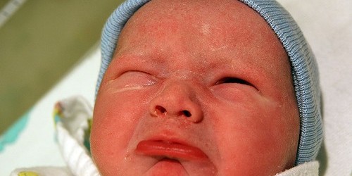 Vaginal Breech Delivery: Is It Safe?