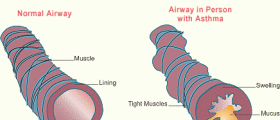 What Is Asthma?