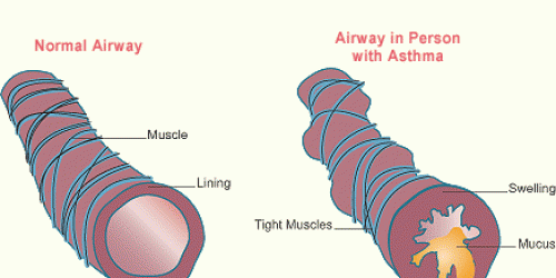 What Is Asthma?