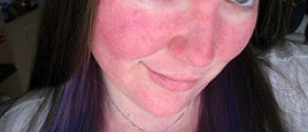 Natural Treatments For Rosacea