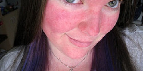 Natural Treatments For Rosacea