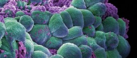 More Than 50% Of Women Affected By Lumpy Breasts Or Fibrocystic Breast Condition