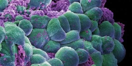 More Than 50% Of Women Affected By Lumpy Breasts Or Fibrocystic Breast Condition