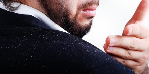 Natural remedies for Seborrheic Dermatitis (Dandruff)