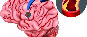 Reducing incidence of stroke with thrombolytics