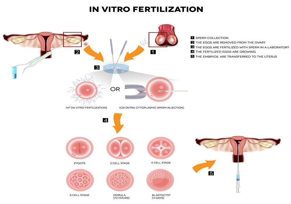 Importance Of In Vitro Fertilization