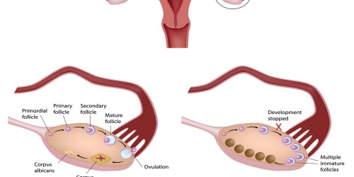 Polycystic ovary syndrome (PCOS)