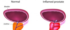 Prostatitis & Sex