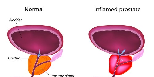 prostatitis shortness of breath)