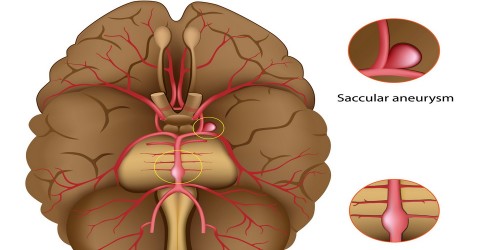 Cerebrovascular disorders: Cerebral Brain Aneurysm
