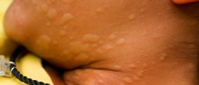 Urticaria (Hives or Angioedema) info