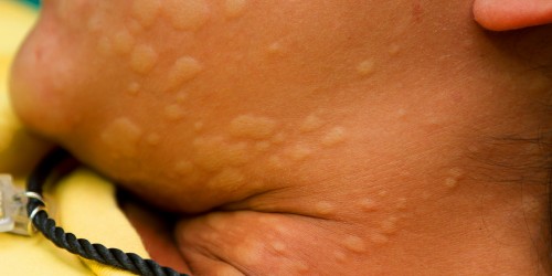 Urticaria (Hives or Angioedema) info