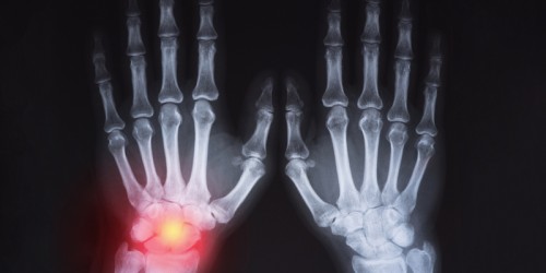 5 Things Arthritis Patients Should Know About Joint Deformity