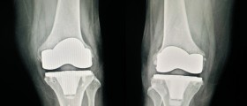 8 Things You Should Know About Complex Or Revision Knee Replacement Surgery