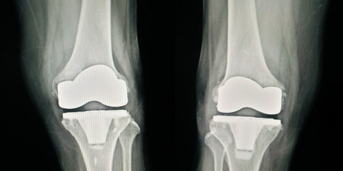 8 Things You Should Know About Complex Or Revision Knee Replacement Surgery
