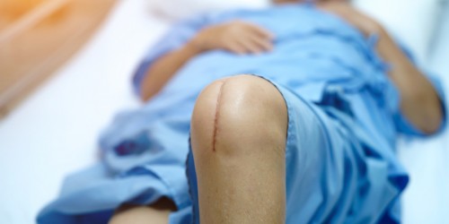 8 Things You Should Know About Total Knee Replacement