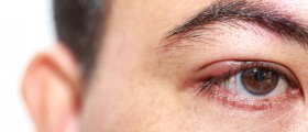 Arthritis And Eye Conditions: 6 Ways Arthritis Affects The Eyes