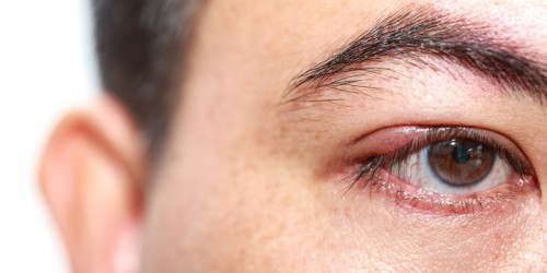 Arthritis And Eye Conditions: 6 Ways Arthritis Affects The Eyes