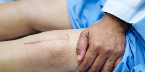 Arthritis Treatment: 4 Things You Should Know About Different Types Of Knee Replacement Surgery