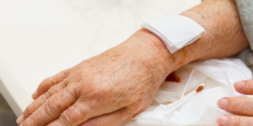 Arthritis and Your Skin: 6 Ways RA Affects Skin Problems