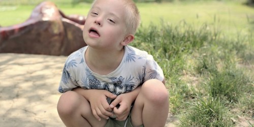 Is There A Connection Between Down Syndrome And Alzheimer's Disease?