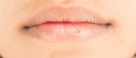 Mouth Conditions And Arthritis: Is It Sjögren’s Syndrome?