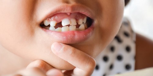 When Should Your Child's Milk Teeth Be Extracted? Will That Affect Your Child's Permanent Teeth?