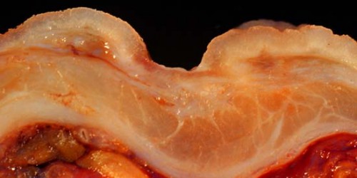 Peptic Ulcer Disease: Everything You Need To Know About Symptoms And Treatment