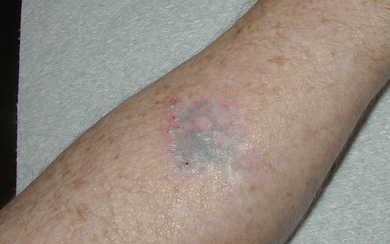 tattoo removal your best options skin u0026 hair problems articles tattoo removal your best options skin u0026 hair problems articles