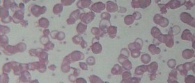 Thalassemia: What Every Parent Needs To Know About A Devastating Blood Disorder