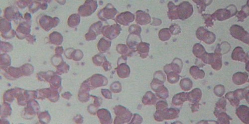 Thalassemia: What Every Parent Needs To Know About A Devastating Blood Disorder