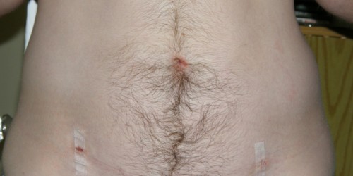 Gastrointestinal Stromal Tumors: Warning Signs, Diagnosis And Treatment