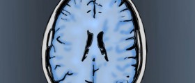 Maybe Alzheimer's Isn't Inflammatory, So What Is To Blame?